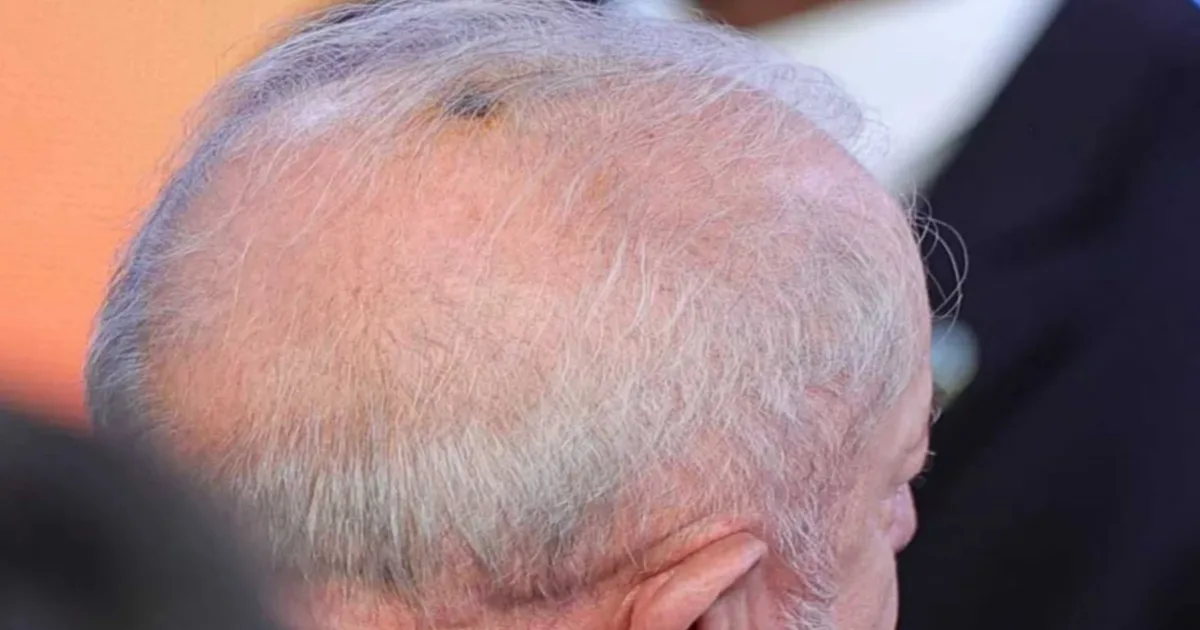 Presidente Lula realiza procedimento médico 1 artigo 83ae96675fec639d2b854a72