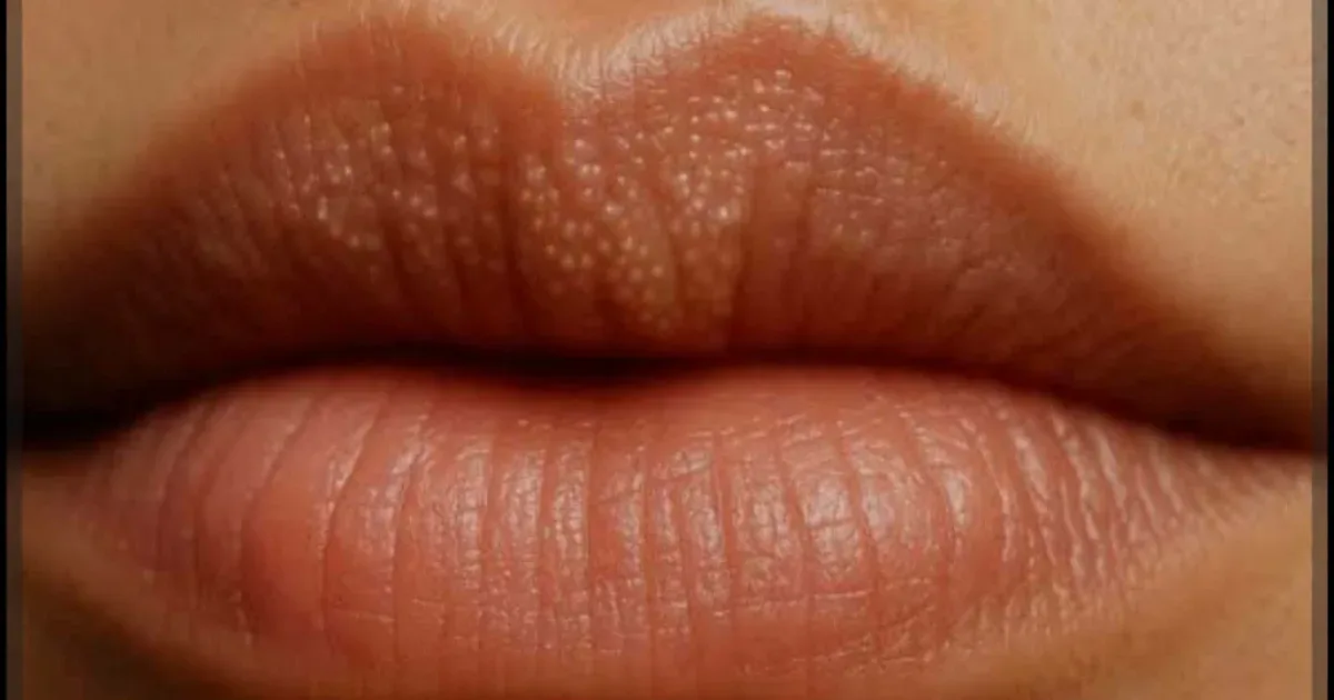 Bolinhas nos lábios: entenda o que são e como tratar 1 Bolinhas nos lábios: entenda o que são e como tratar