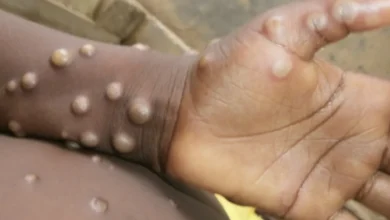 Primeiro caso de Mpox é confirmado em Porto Alegre