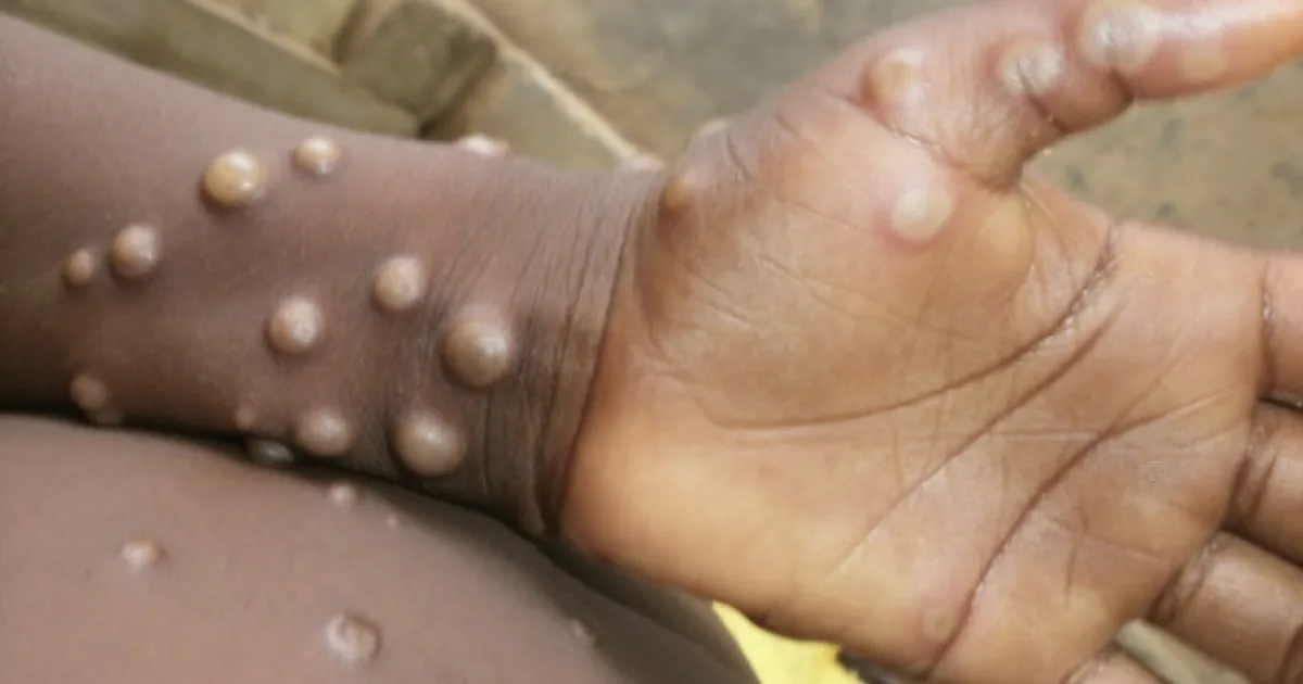 Primeiro caso de Mpox é confirmado em Porto Alegre 1 Primeiro caso de Mpox é confirmado em Porto Alegre