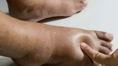 Como diabetes e doenças cardíacas afetam a saúde dos pés