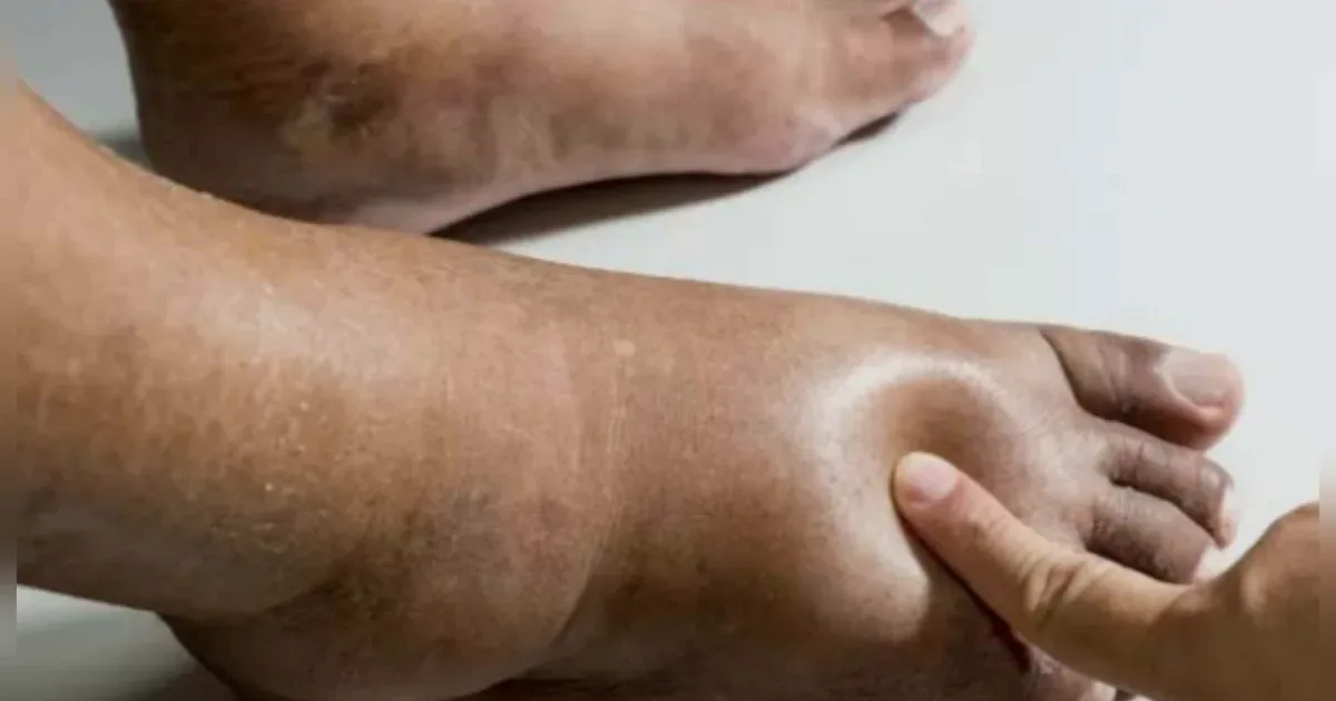 Como diabetes e doenças cardíacas afetam a saúde dos pés 1 Como diabetes e doenças cardíacas afetam a saúde dos pés