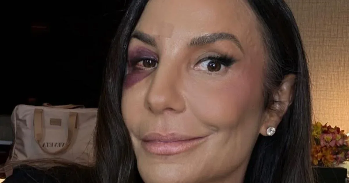 Pesquisador suspeita que olho roxo de Ivete Sangalo seja seita 1 Pesquisador suspeita que olho roxo de Ivete Sangalo seja seita